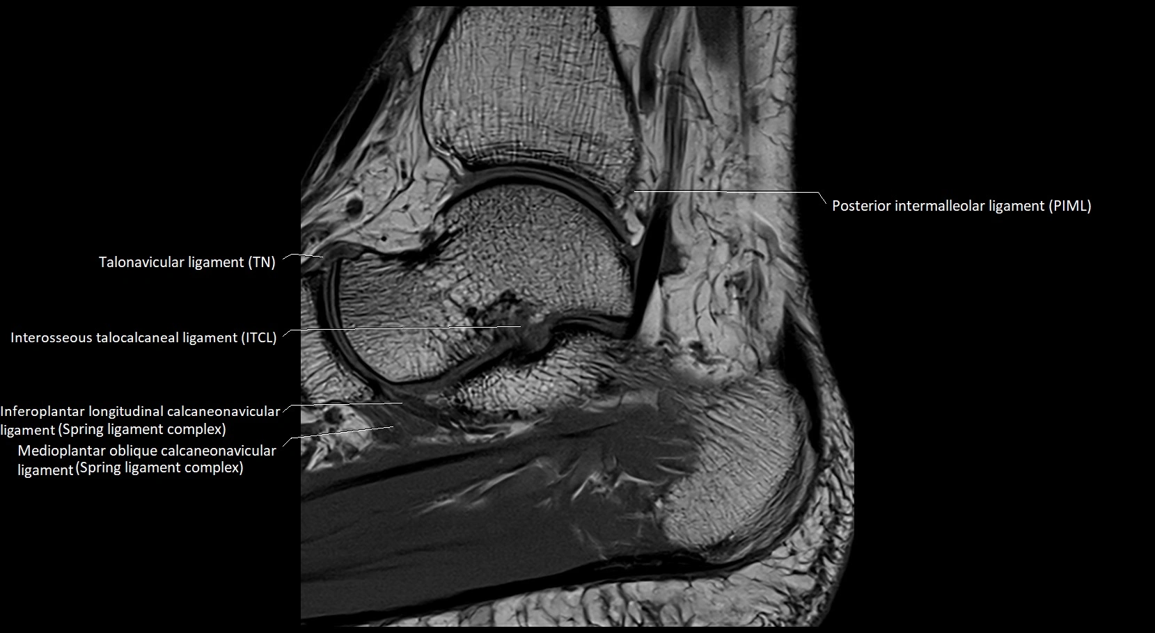 MRI ankle ligaments anatomy sagittal 3T image 11.webp